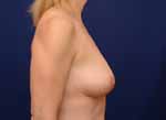 breast reconstruction before and after photos