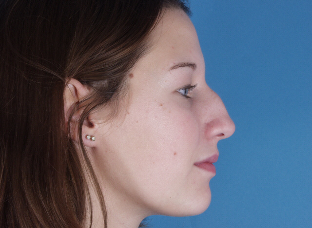 rhinoplasty before and after pictures