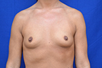 Breast Augmentation Before and After Pictures