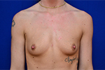 Breast Augmentation Before and After Photos