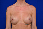Breast Augmentation Before and After Photos