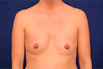 Breast Augmentation Before and After Photos