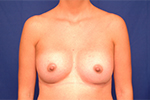 Breast Augmentation Before and After Pictures