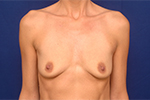 Breast Augmentation Before and After Pictures
