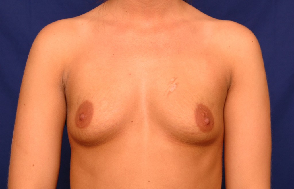Breast Augmentation Before and After Pictures