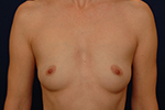 breast augmentation before and after pictures