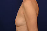 breast augmentation before and after pictures