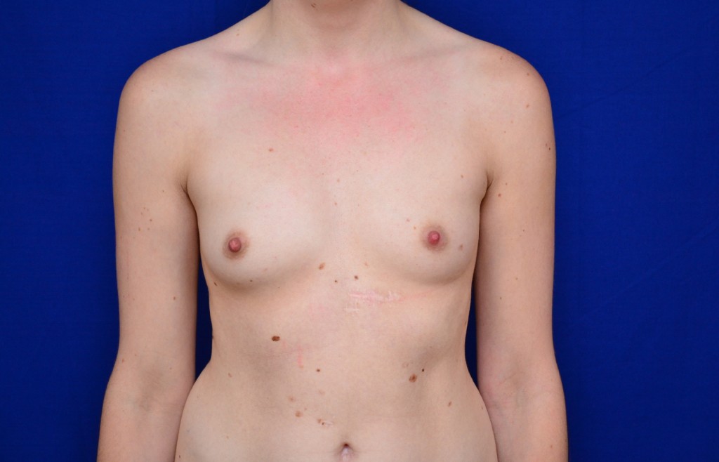 Breast Augmentation Before and After Photos
