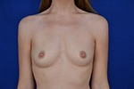 breast augmentation before and after photos