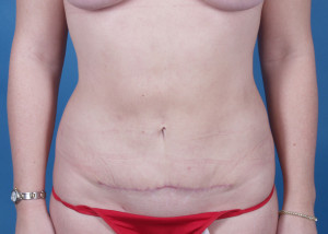 Mini Tummy Tuck Before & After Pictures Green, OH