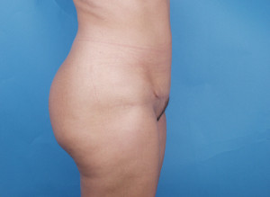 Mini Tummy Tuck Before & After Pictures Green, OH