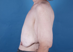 Breast Reconstruction Before & After Pictures Green, OH