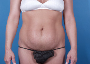 Tummy Tuck Before & After Pictures Green, OH