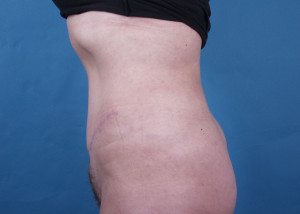 Tummy Tuck Before & After Pictures Green, OH