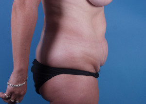 Tummy Tuck Before & After Pictures Green, OH