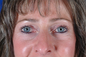 Blepharoplasty Before & After Pictures Green, OH