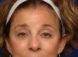 Eyelid Surgery Before & After Pictures Green, OH