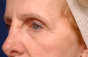 Eyelid Surgery Before & After Pictures Green, OH