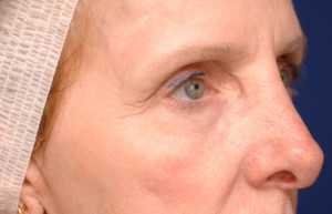 Eyelid Surgery Before & After Pictures Green, OH