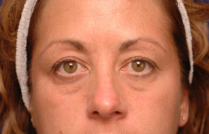 Eyelid Surgery Before & After Pictures Green, OH