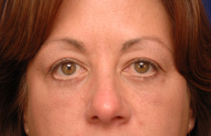 Eyelid Surgery Before & After Pictures Green, OH