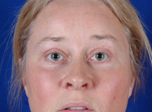 Eyelid Surgery Before & After Pictures Green, OH