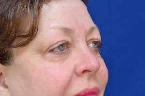 Eyelid Surgery Before & After Pictures Green, OH