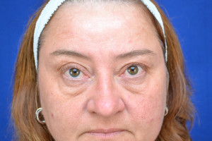 Eyelid Surgery Before & After Pictures Green, OH