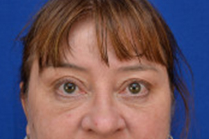 Eyelid Surgery Before & After Pictures Green, OH