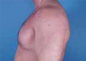 Gynecomastia Before & After Pictures Green, OH