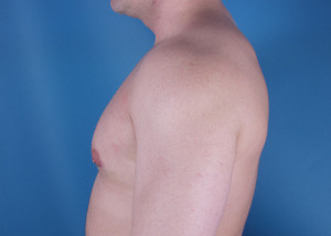 Gynecomastia Before & After Pictures Green, OH