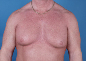 Gynecomastia Before & After Pictures Green, OH