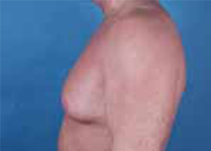 Gynecomastia Before & After Pictures Green, OH