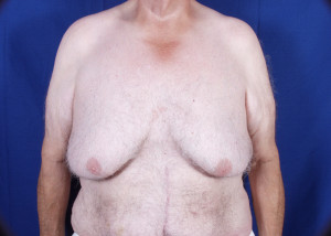 Gynecomastia Before & After Pictures Green, OH