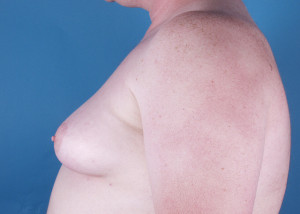 Gynecomastia Before & After Pictures Green, OH