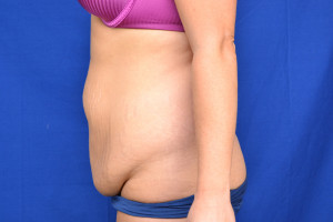 Tummy Tuck Before & After Pictures Green, OH