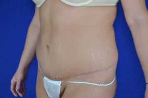 Tummy Tuck Before & After Pictures Green, OH