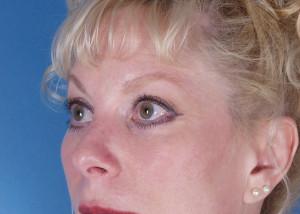 Blepharoplasty Before & After Pictures Green, OH