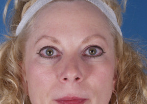 Blepharoplasty Before & After Pictures Green, OH