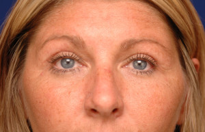 Eyelid Surgery Before & After Pictures Green, OH