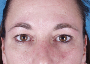 Brow Lift Before & After Pictures Green, OH