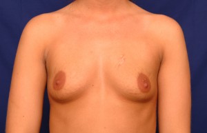 Breast Augmentation Before & After Pictures Green, OH