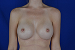 Breast Augmentation Before & After Pictures Green, OH