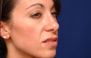 Cheek Implants Before & After Pictures Green, OH