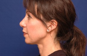 Cheek Implants Before & After Pictures Green, OH