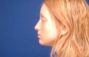 Cheek Implants Before & After Pictures Green, OH