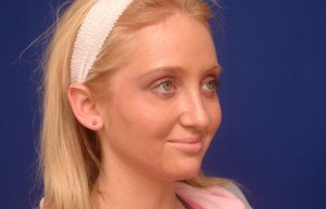 Cheek Implants Before & After Pictures Green, OH