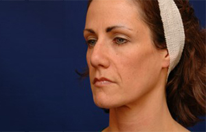 Cheek Implants Before & After Pictures Green, OH