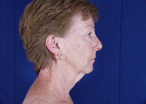 Facelift Before & After Pictures Green, OH