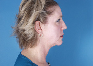 Facelift Before & After Pictures Green, OH